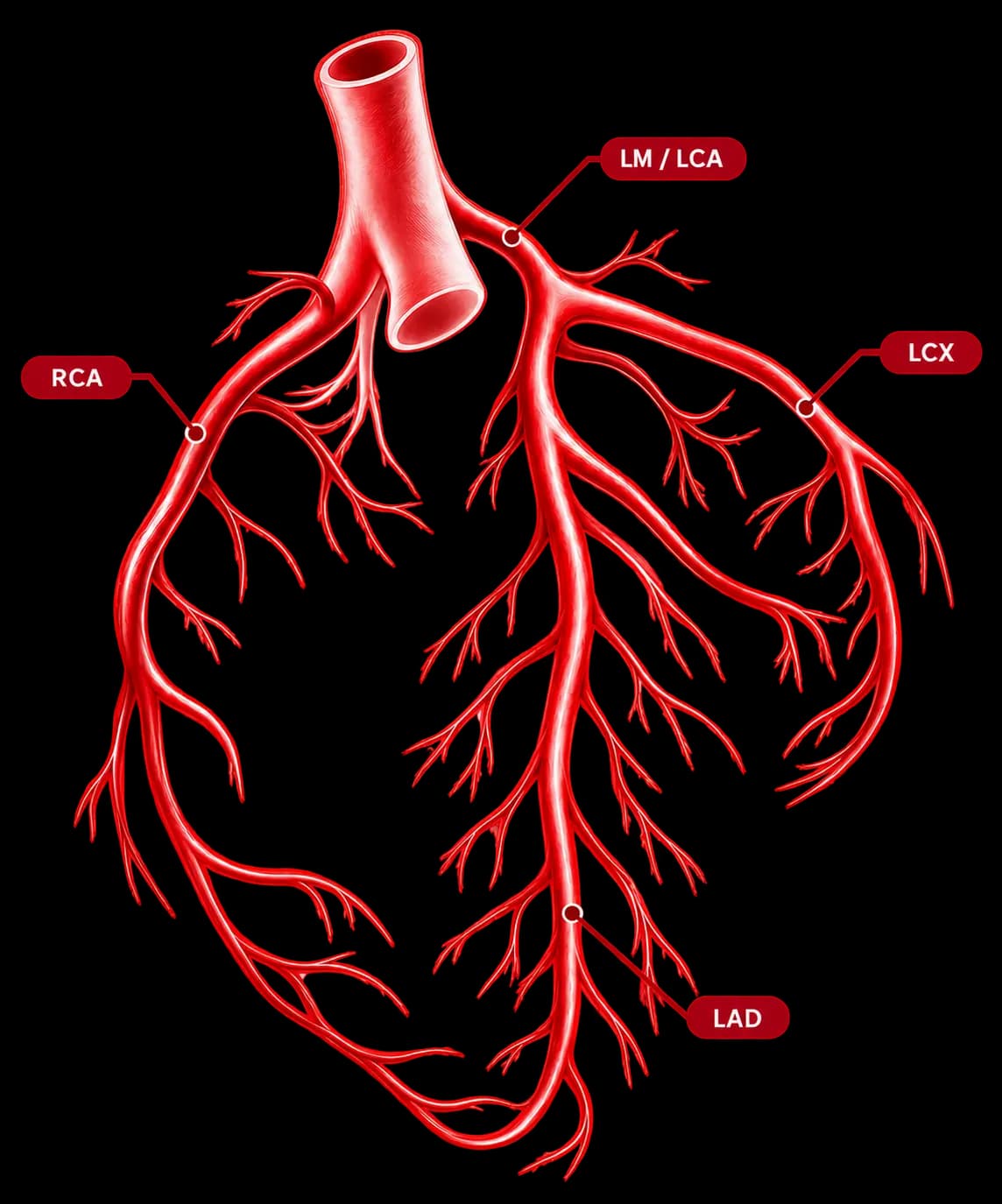 Koroner arterlerin (RCA, LM/LCA, LCX, LAD) dallanmasını gösteren tıbbi illüstrasyon